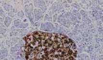 Pancreas Microcitoma