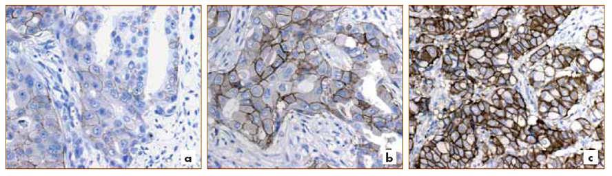 Espressione di HER2 nel carcinoma della mammella Le colorazioni immunoistochimiche possono dare indicazioni semiquantitative sui livelli di espressione della proteina (c-erb2) codificata dal gene