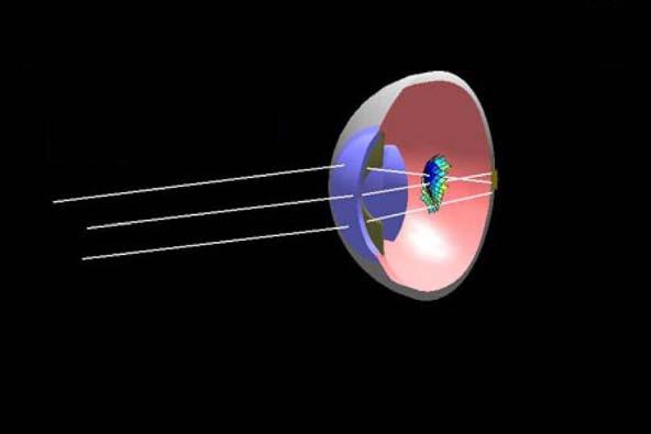Durante il passaggio nei mezzi ottici oculari, anche una minima alterazione sulla sfericità del fronte d onda comporta la formazione di un immagine non puntiforme, definita aberrata.