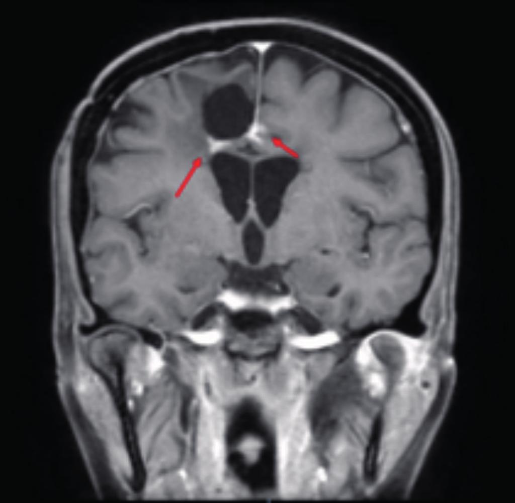 T. Prochilo Figura 1. Risonanza magnetica (RM) encefalica eseguita nel settembre 2014: progressione di malattia lungo il bordo del cratere chirurgico. Figura 2.