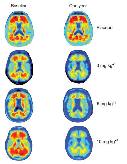 ADUCANUMAB Effetti sull imaging (PET con Florbetapir): ADUCANUMAB riduce il carico di amiloide alla