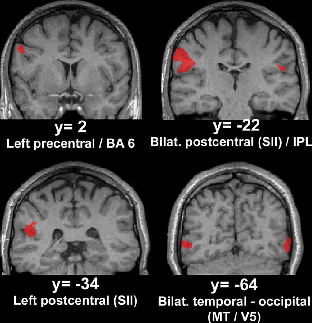 Left SII Right SII Conjunction (Nichols et al.