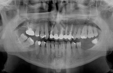 Sensore intercambiabile Soddisfa le esigenze dell imaging panoramico e cefalometrico con un solo sensore: una soluzione Pan-Ceph con