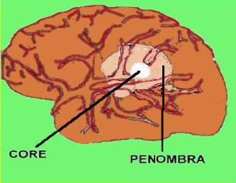 IPERTENSIONE ARTERIOSA La presenza di ipertensione è molto frequente nei pazienti con ictus.