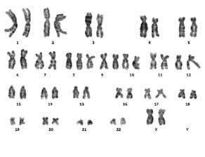 18, 13, X e Y), non possono individuare aneuploidie cromosomiche sui cromosomi non indagati. Il PrenatalSafe Karyo ha permesso di rilevare un'aneuploidia a mosaico.