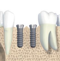 3.1.1.2 Esempi relativi a lacune di denti singoli Nei seguenti esempi sono riportate le modalità di applicazione delle regole 1 e 2 in presenza di lacune di più denti.