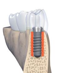 3.1.2 Orofaziale Implantatposition Per garantire condizioni stabili dei tessuti duri e molli, la dimensione oro-facciale e palatale dell osso deve avere uno spessore minimo di 1 mm.