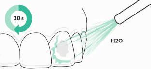 2. Per il successo del trattamento è importante un buon isolamento del campo operatorio. È necessario pertanto isolare il dente con una diga di gomma o una diga fotopolimerizzabile.