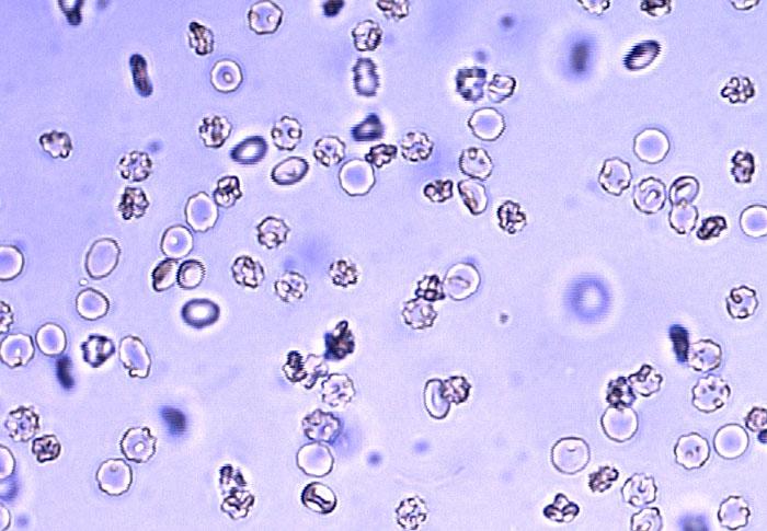 Cellule di forma normale Globuli rossi diluiti in un mezzo ipertonico