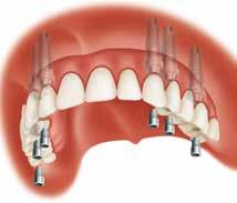 Scegli il protocollo implantare più adatto 2 I nostri Monconi Conici Angolati Zimmer Biomet Dental offrono la libertà di scegliere il protocollo implantare