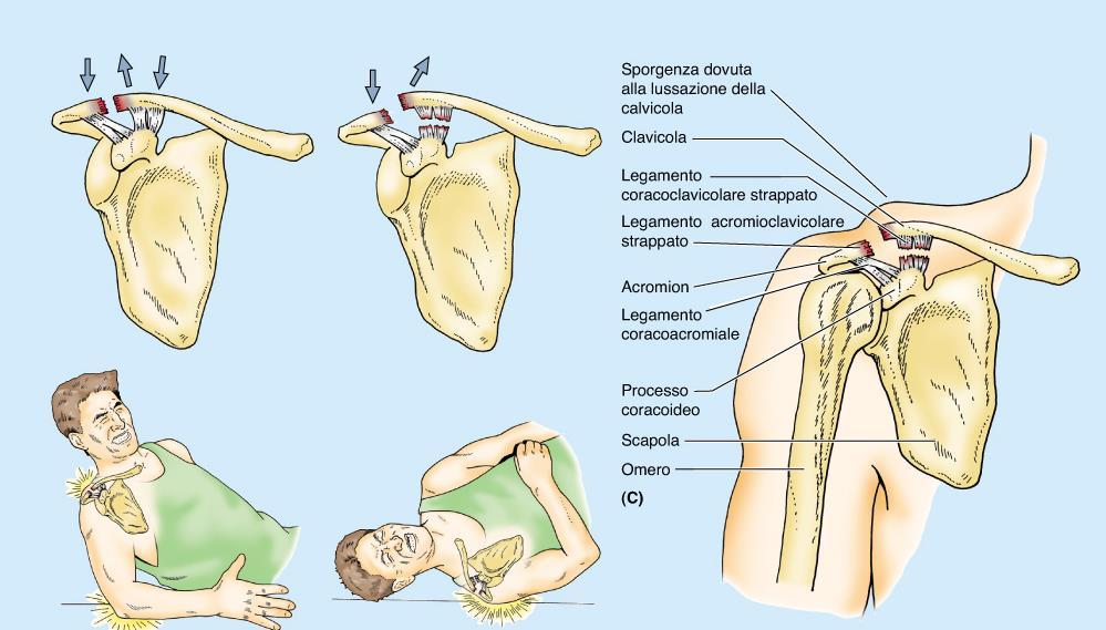 A Trauma indiretto Distorsione: lesione lig cromio-clavicolare No lussazione B Trauma diretto Distorsione (lesione anche del lig coraco-clavicolare) Lussazione