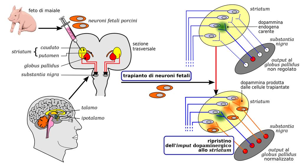 Trattamento del morbo di Parkinson con il trapianto di neuroni porcini fetali igura 47.6.