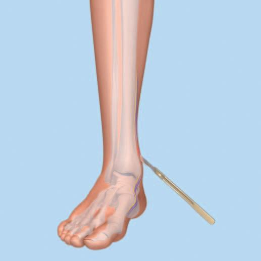 Approccio Praticare un incisione mediale attraverso la cute e il sottocute al di sopra del livello dell articolazione della caviglia.