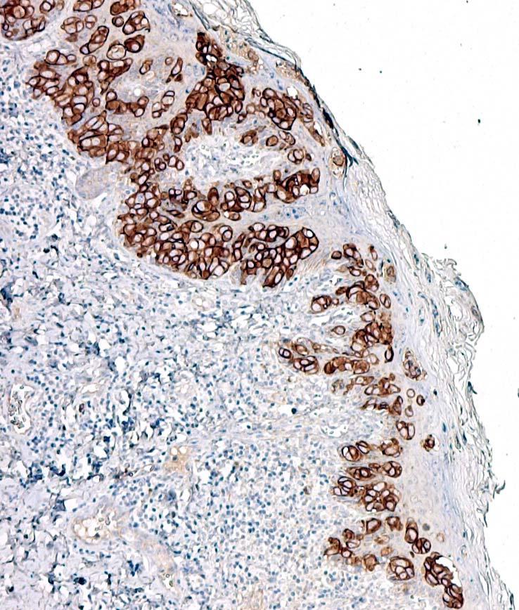 Carcinoma