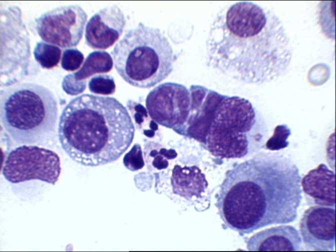 CARCINOMI: QUADRO CITOLOGICO Cellule piccole Isolate o in piccoli gruppi Nuclei con cromatina fine,