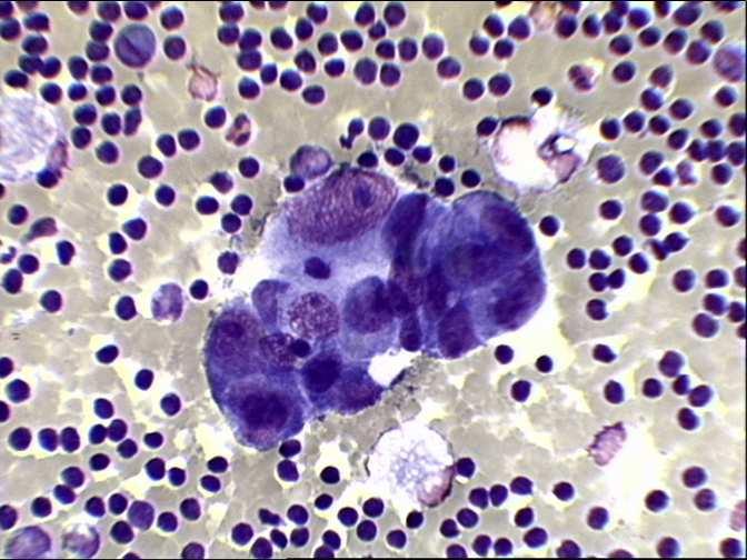 CARCINOMI: QUADRO CITOLOGICO Aggregati di cellule pleomorfe, con caratteri nucleari di malignità, e talora vacuoli citoplasmatici contenenti muco (polmone, ovaio, tratto