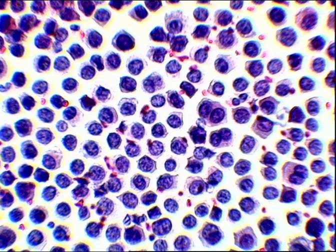 CARCINOMI: QUADRO CITOLOGICO Cellule isolate o in piccoli aggregati, con caratteri di malignità, di natura epiteliale (polmone, pancreas).