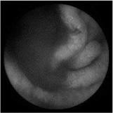 INDICAZIONI Riguardano essenzialmente le patologie dell intestino tenue - Definite Sanguinamento gastrointestinale di origine oscura Morbo di Crohn