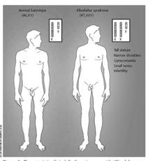 Sindrome di Klinefelter aspetti clinici IPOGONADISMO IPERGONADOTROPO IPOTROFIA TESTICOLARE INFERTILITA GINECOMASTIA STATURA AUMENTATA ARTI ALLUNGATI OSTEOPOROSI RITARDO MOTORIO DIFFICOLTA