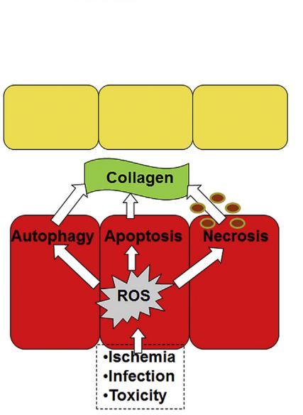 a perdita di cardiomiociti e fibrosi