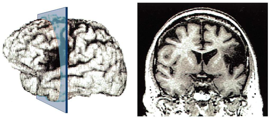 Il neurologo francese Pierre Marie (1857-1940) ritenne che una funzione complessa come il linguaggio non poteva essere controllata solo da una