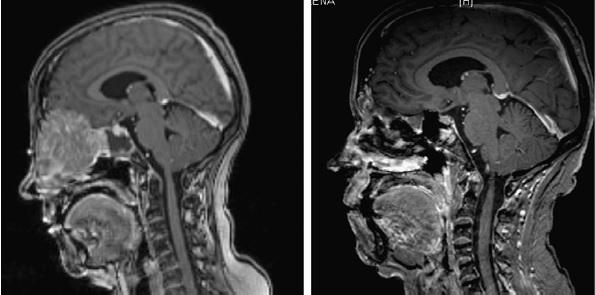 4.1 Principali applicazioni cliniche e risultati ottenuti all estero 23 Figura 4.1: Confronto tra MRI effettuata prima della BNCT (sinistra) e dopo la BNCT (destra).