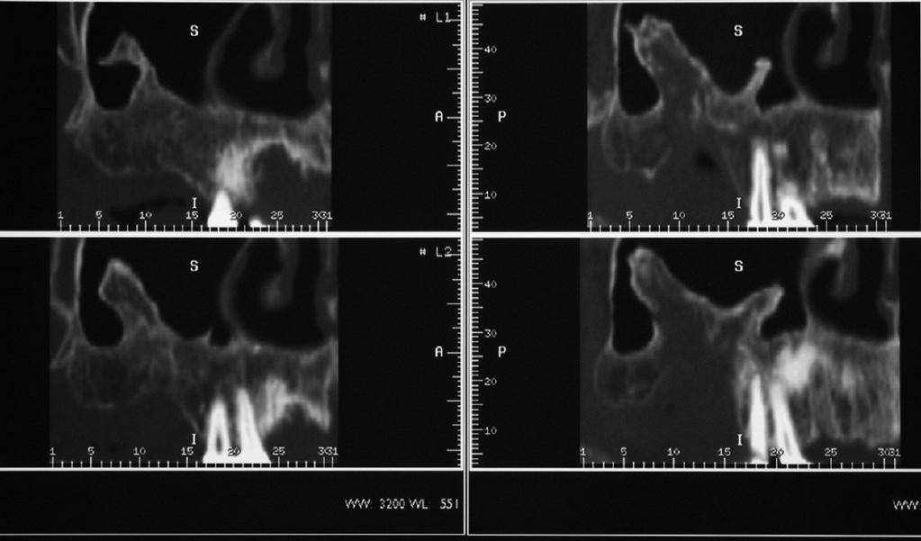 Radiopacità del seno mascellare in un caso di crescita ossea anomala Fig. 2 Tomografia computerizzata che mostra l estensione della radiopacità sul piano verticale Fig.