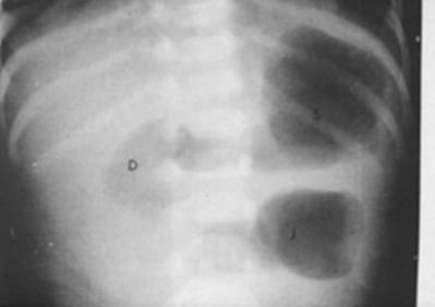 Rx diretta in ortostatismo Atresia digiunale: - stomaco, duodeno e digiuno prossimale sono