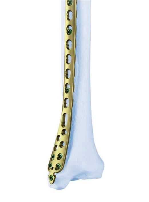 PLACCA LCP PER TIBIA DISTALE La placca LCP per tibia distale è parte integrante del sistema LCP Synthes che riunisce la tecnologia delle viti di bloccaggio con le tecniche di fissazione con placche