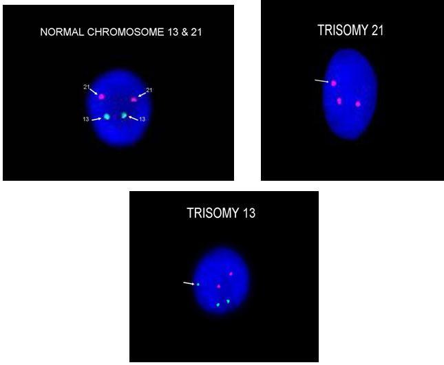 Prenatal Diagnosis of Anueploidies by FISH