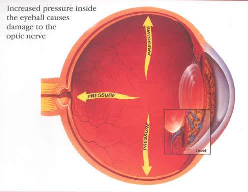 Glaucoma Prostaglandine F2alfa topiche nel trattamento del glaucoma ad angolo aperto Il glaucoma, una malattia a carattere progressivo del nervo ottico, rappresenta una importante causa di cecità in