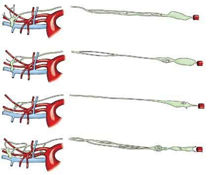 110 CAPITOLO 3 Il collo, il torace e l arto toracico Tronco tracheale sinistro Dotto toracico Vena cervicale superficiale Arteria succlavia sinistra Dotto toracico Cisterna del chilo Aorta Tronco