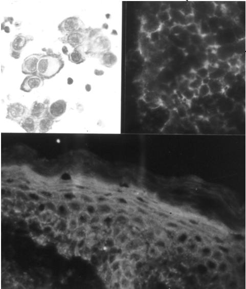 PEMFIGO DIAGNOSI IFD: depositi intercellulari di IgG e C3 su epitelio della cute perilesionale.