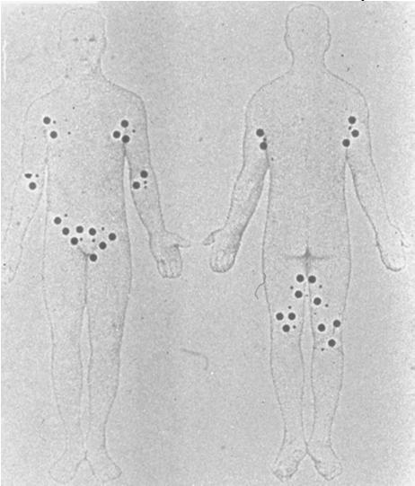 PEMFIGOIDE BOLLOSO QUADRO CLINICO Fase iniziale (orticarioide): chiazze eritemato-pomfoidi, tondeggianti, del diametro di alcuni cm, fortemente pruriginose.