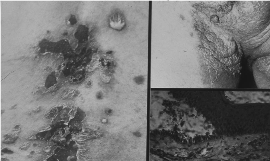 Acantolisi bassa PEMFIGO QUADRI CLINICI Pemfigo volgare: erosioni orali; bolle flaccide insorgenti su cute apparentemente