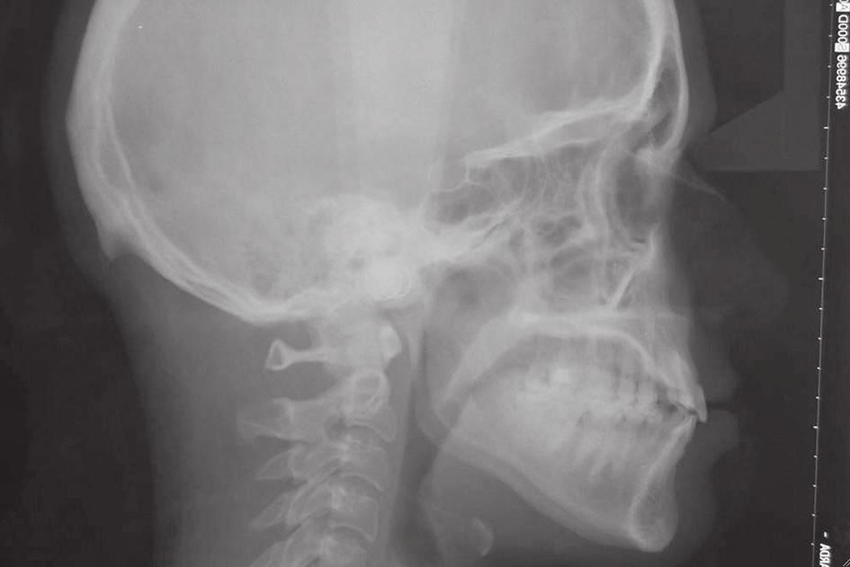 Gestione della distalizzazione canina con le mini-screw in un trattamento ortodontico SW MBT estetico per terapia implantare Z1 connect TBR Case report I Carlo Brogna Grazia Castellucci Il successo