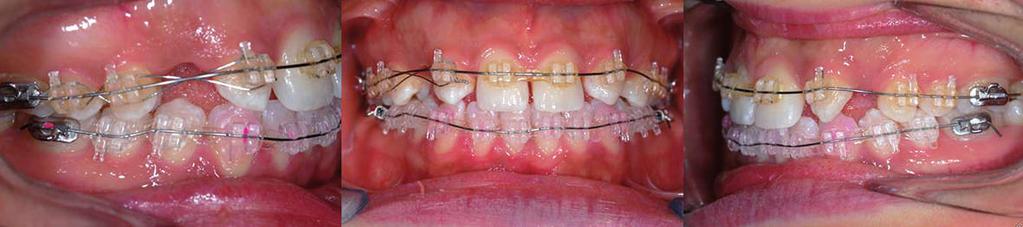 1 mese 4 mese 7 mese 4. Trattamento ortodontico SW MBT a 4 mesi. 5.