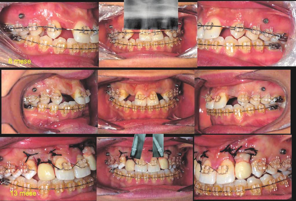 9. Trattamento ortodontico SW MBT a 8 mesi. 10.