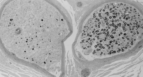 Biopsia di nervo perdita di fibre focale o