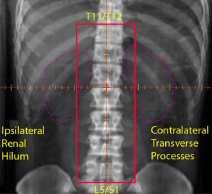 Razionale: L evoluzione del drawing film planning al computerised tomogram (CT) based planning permette di conformare l erogazione l RT sul target dettagliando la dosimetria su tutti i