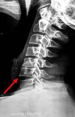 Figura 6 Le frecce in rosso mostrano tre diverse componenti che determinano il quadro di mielopatia cervicale visibili ad esame radiografico.