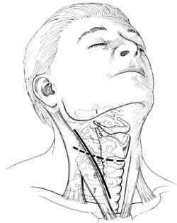 TRATTAMENTO CHIRURGICO Il trattamento della mielopatia cervicale spondilogenetica è essenzialmente chirurgico.