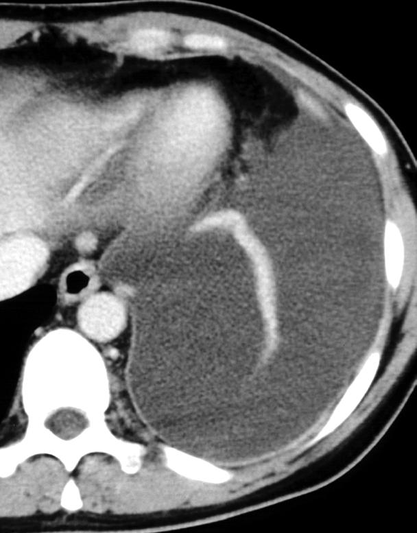 Mesotelioma Pleurico Maligno Contrast enhanced CT (CECT) CT sign suggestive of MPM Unilateral pleural effusion (74%)