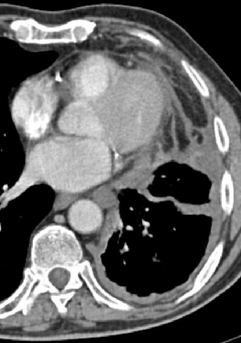 Mesotelioma Pleurico Maligno Contrast enhanced CT (CECT) CT sign suggestive of MPM Unilateral pleural effusion (74%)