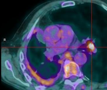 SUVmax survival) FP pleurodesis and inflammation Compared