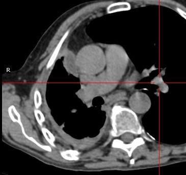 extra-thoracic lymphadenopathy and metastatic disease