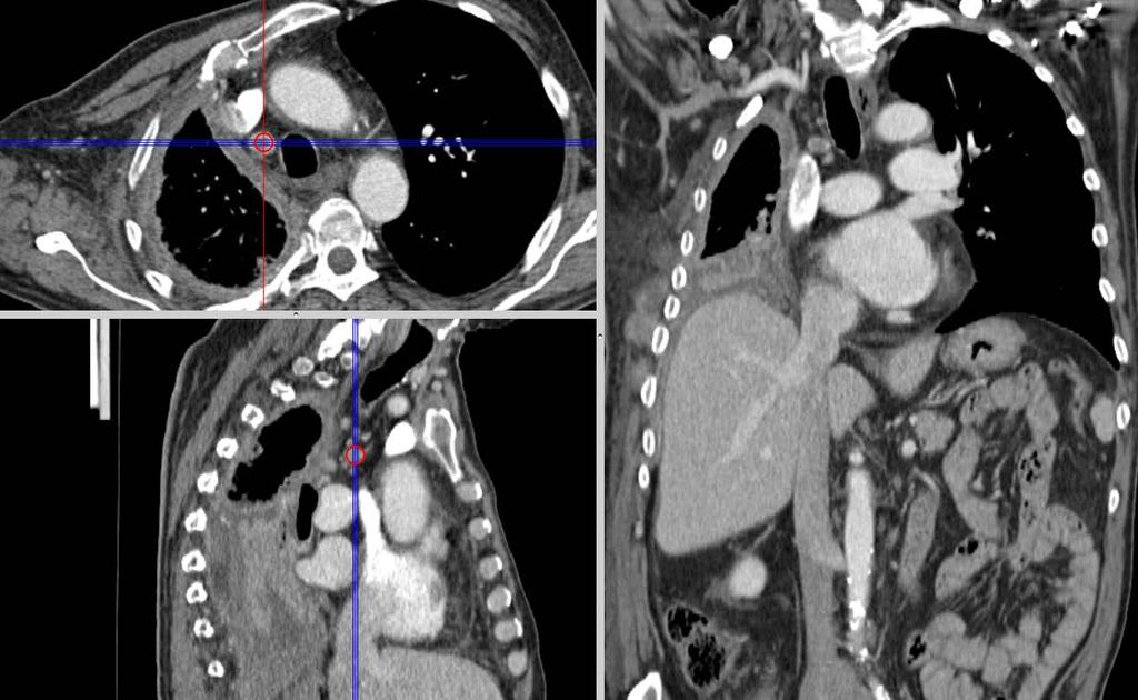 Mesotelioma Pleurico Maligno lymphadenopathy PET/CT vs CECT Nickell LT jr