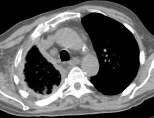 Mesotelioma Pleurico Maligno