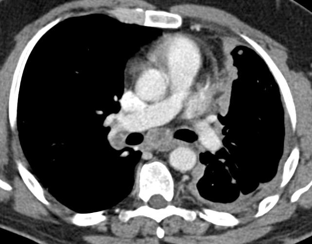 Mesotelioma