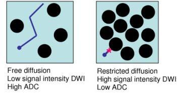 DWI signal would decreases